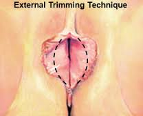 روش اول جراحی لابیاپلاستی - عمل زیبایی واژن